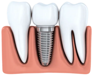 dental implant