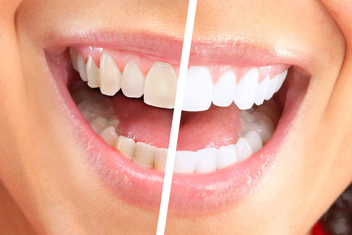 What causes white spots on teeth?
