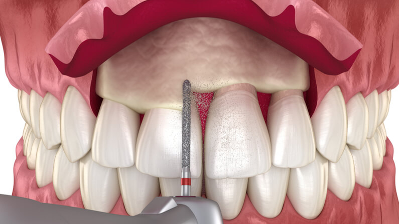 Frontal crown lengthening - gingivectomy procedure