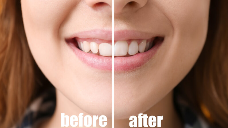 Gingivectomy procedure before and after