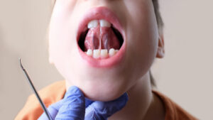 boy showing the length of frenum of his tongue