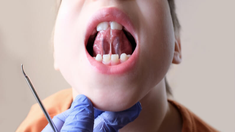 https://www.mybrownstonedental.com/wp-content/uploads/2021/11/boy-showing-the-length-of-frenum-of-his-tongue.jpg