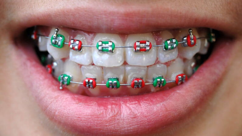 color combination braces