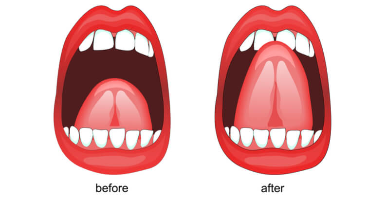 frenulum procedure before and after under tongue