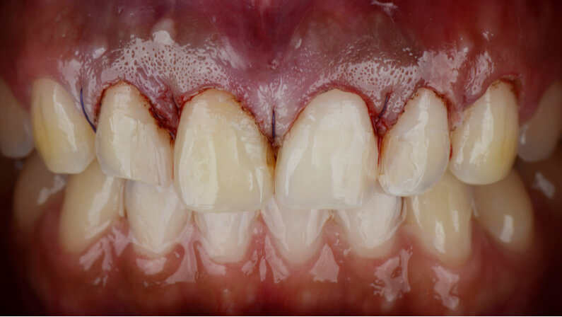 gingivectomy after surgery