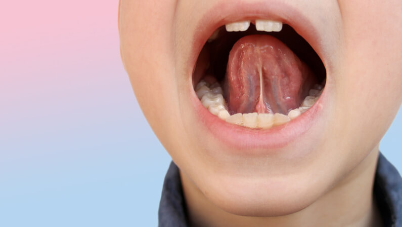 boy frenulum underside tongue -lingual frenum