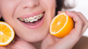 what color braces should you get