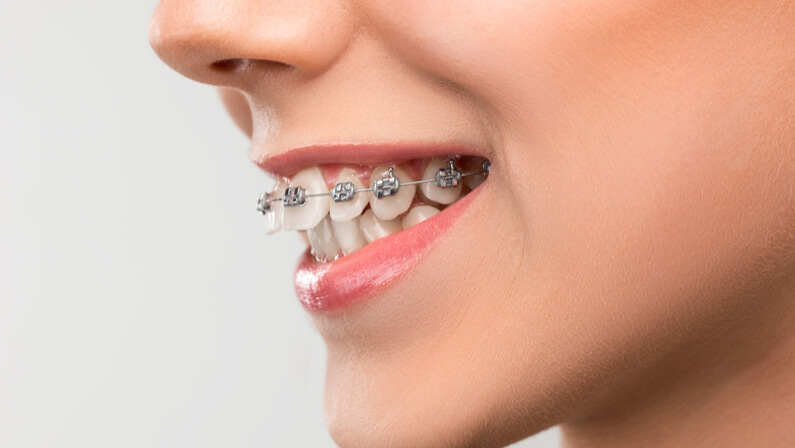 overbite treatment options