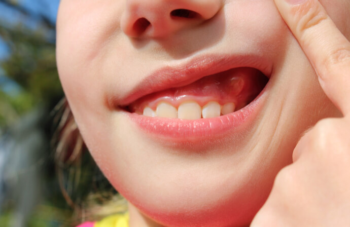 Sore Gums Causes
