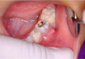 Tooth Infection Spreading_ Treatments, When to See a Doctor