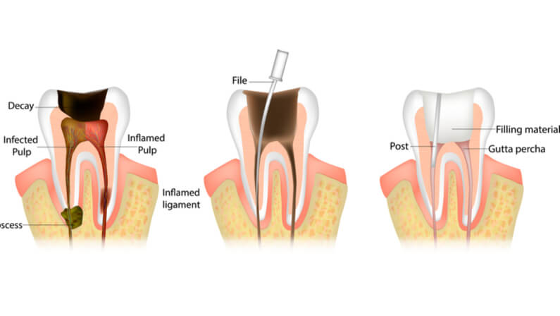 Root canal treatment process