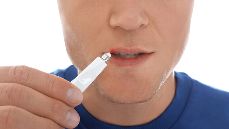 man applying cream to cold sore