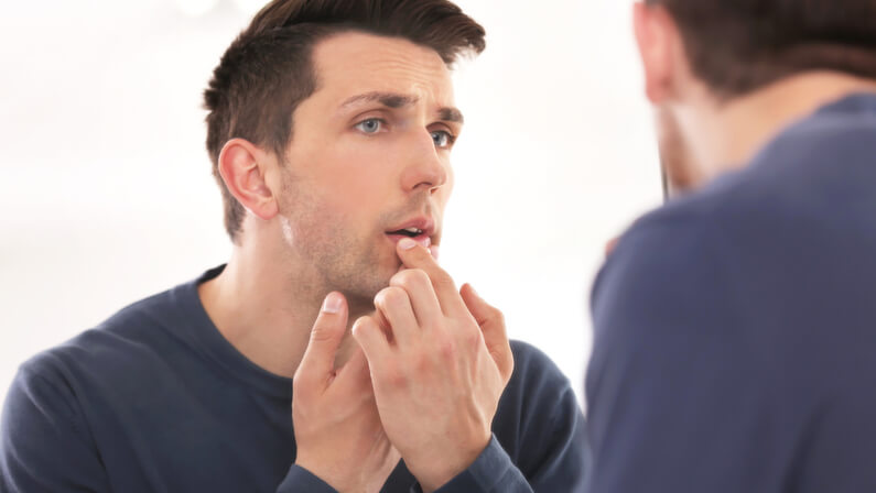 young man with a cold sore