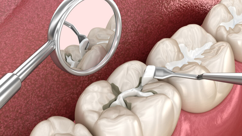 Dental Fillings procedure