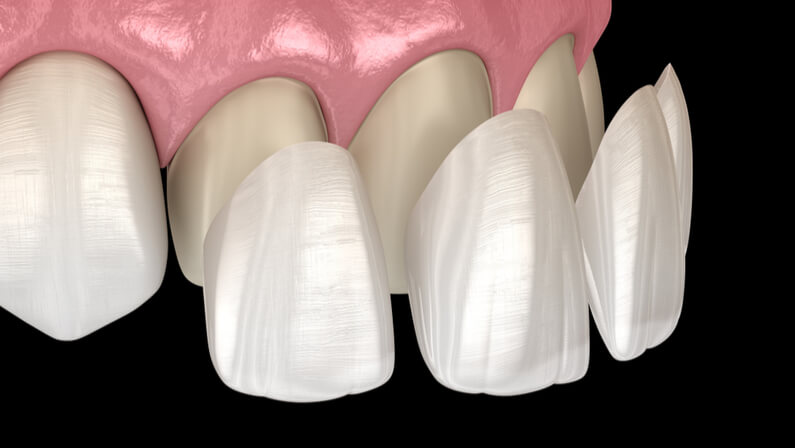 Porcelain Veneers for teeth