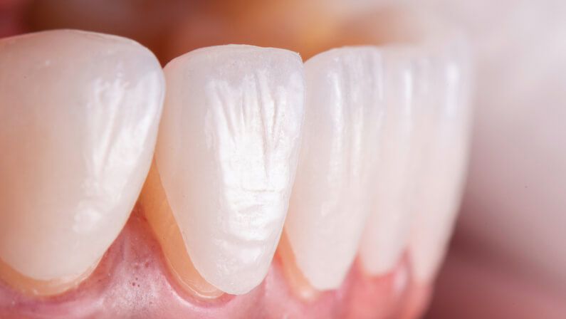 Porcelain Veneers on a patient