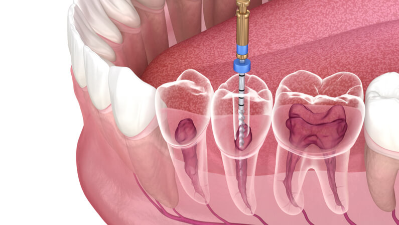 Root Canals procedure