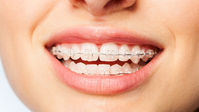 ceramic braces