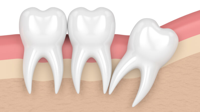 distal impaction wisdom tooth