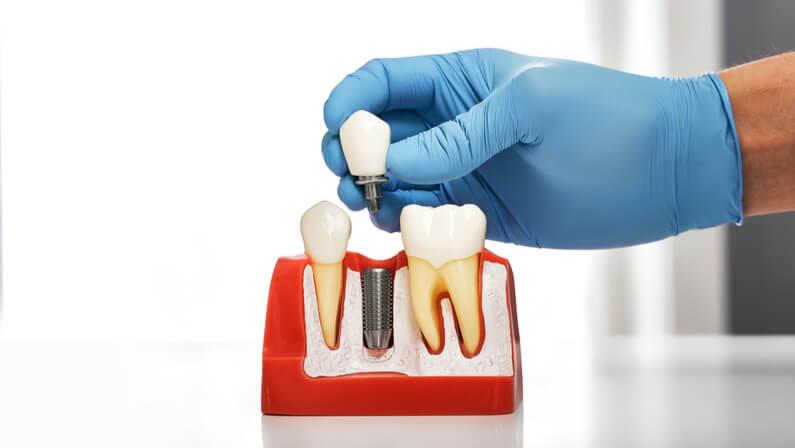 doctor illustrating dental implant