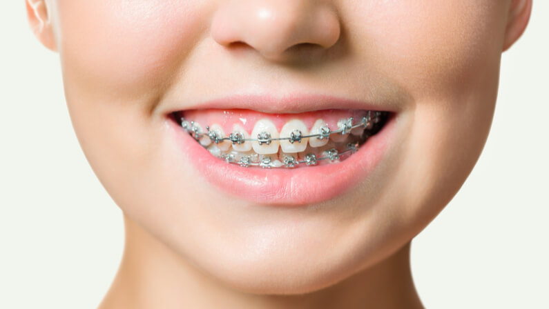 female with metal braces