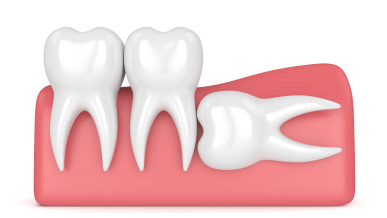 horizontal impaction wisdom tooth