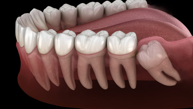 impacted wisdom tooth