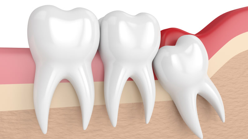 mesial impaction wisdom tooth