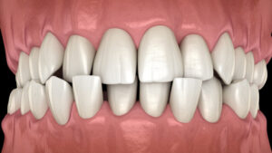 misaligned teeth