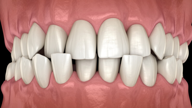 https://www.mybrownstonedental.com/wp-content/uploads/2022/06/misaligned-teeth.jpg