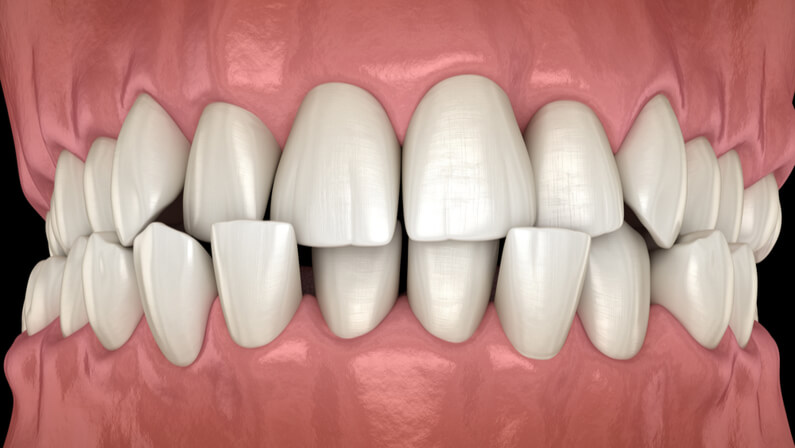 misaligned teeth