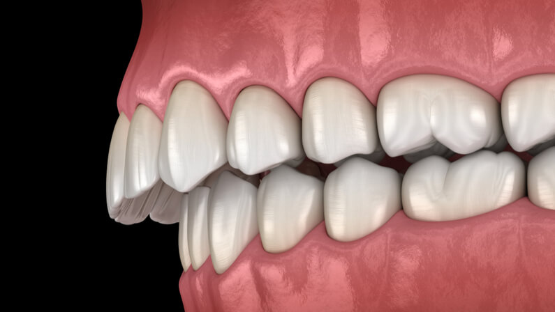 overbite teeth