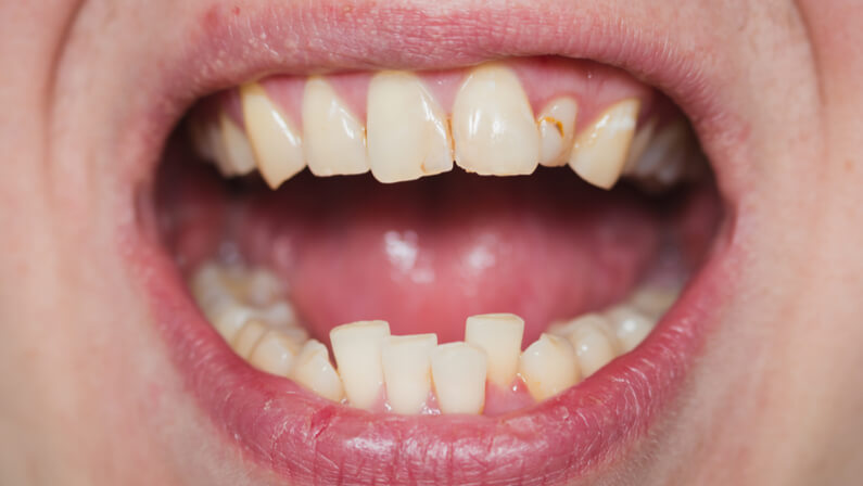 person with misaligned teeth