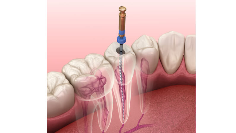 root canal procedure