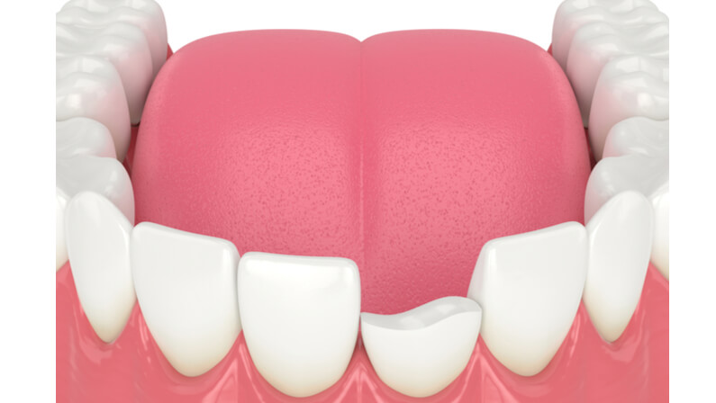 sample of a chipped tooth