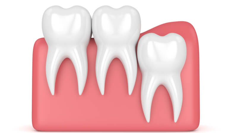 vertical impaction wisdom tooth