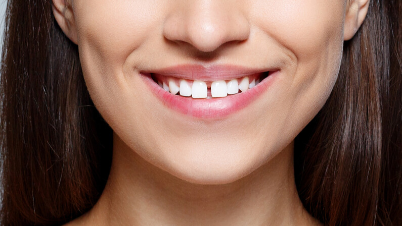 woman with gap on teeth