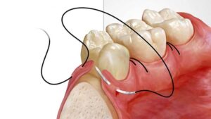 Alveoloplasty