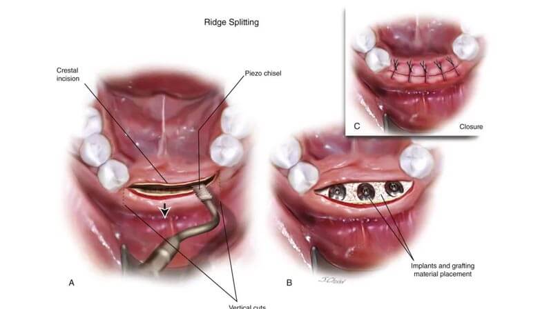 Alveoloplasty procedures