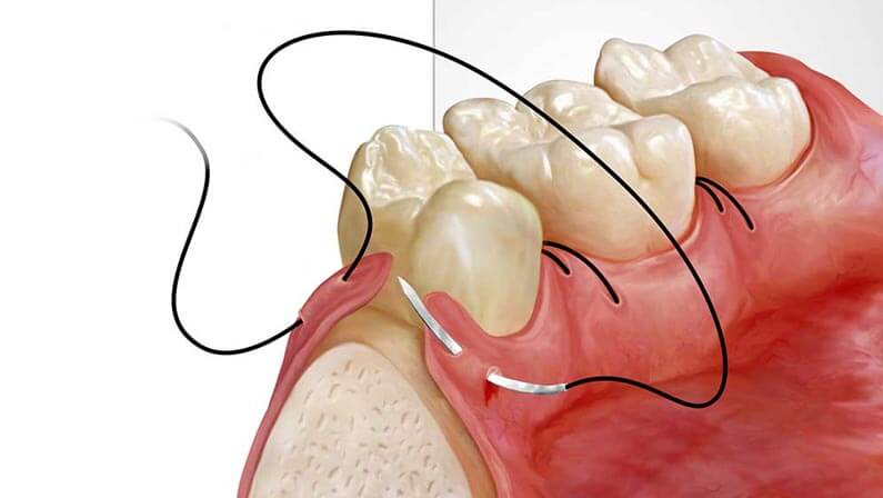 Alveoloplasty