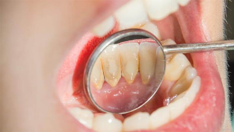 plaques on a person teeth