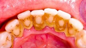 plaques on teeth