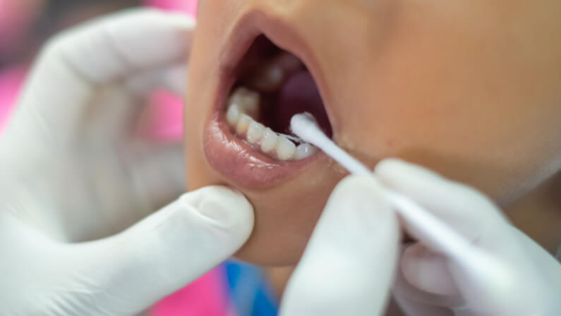 fluoride treatment in a child