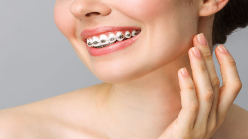 woman's braces