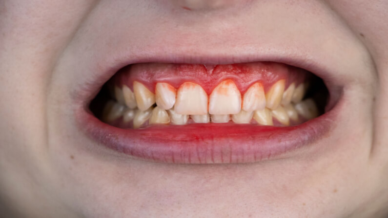 bleeding gums