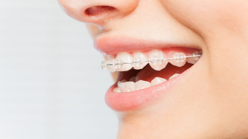 lady with ceramic braces