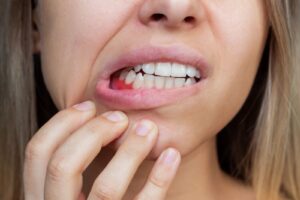 Understanding Gum Disease: Symptoms, Treatment, and Prevention