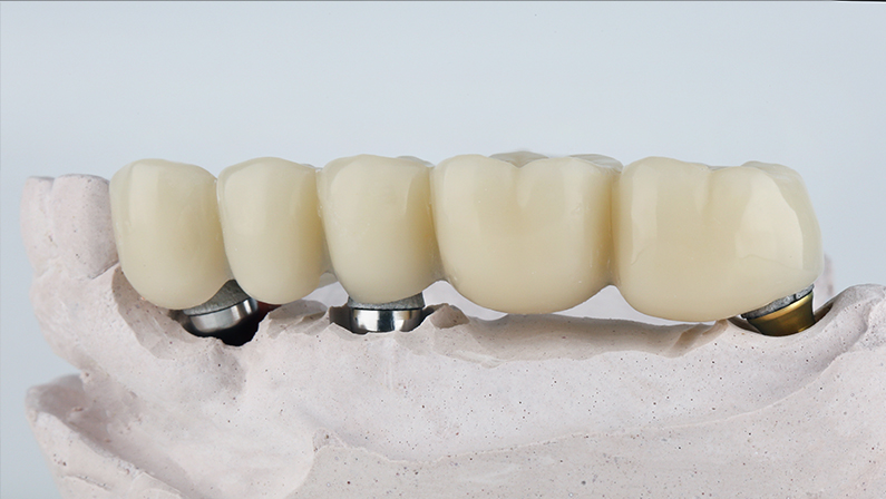 dental bridge prosthesis of five chewing teeth on a beam with a model