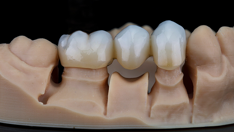 zirconium dental crowns on a model made on a 3D printer, shot on black glass with reflection