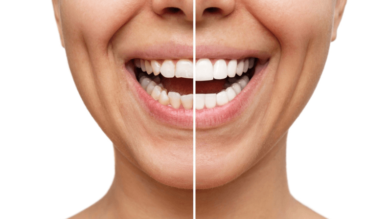 Cropped shot of a young caucasian smiling woman before and after veneers installation isolated on a white background. Teeth whitening. Dentistry, dental treatment. Comparison of the shape of teeth